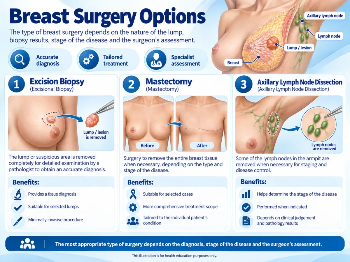Infographic of breast surgery options, including wide local excision and mastectomy.