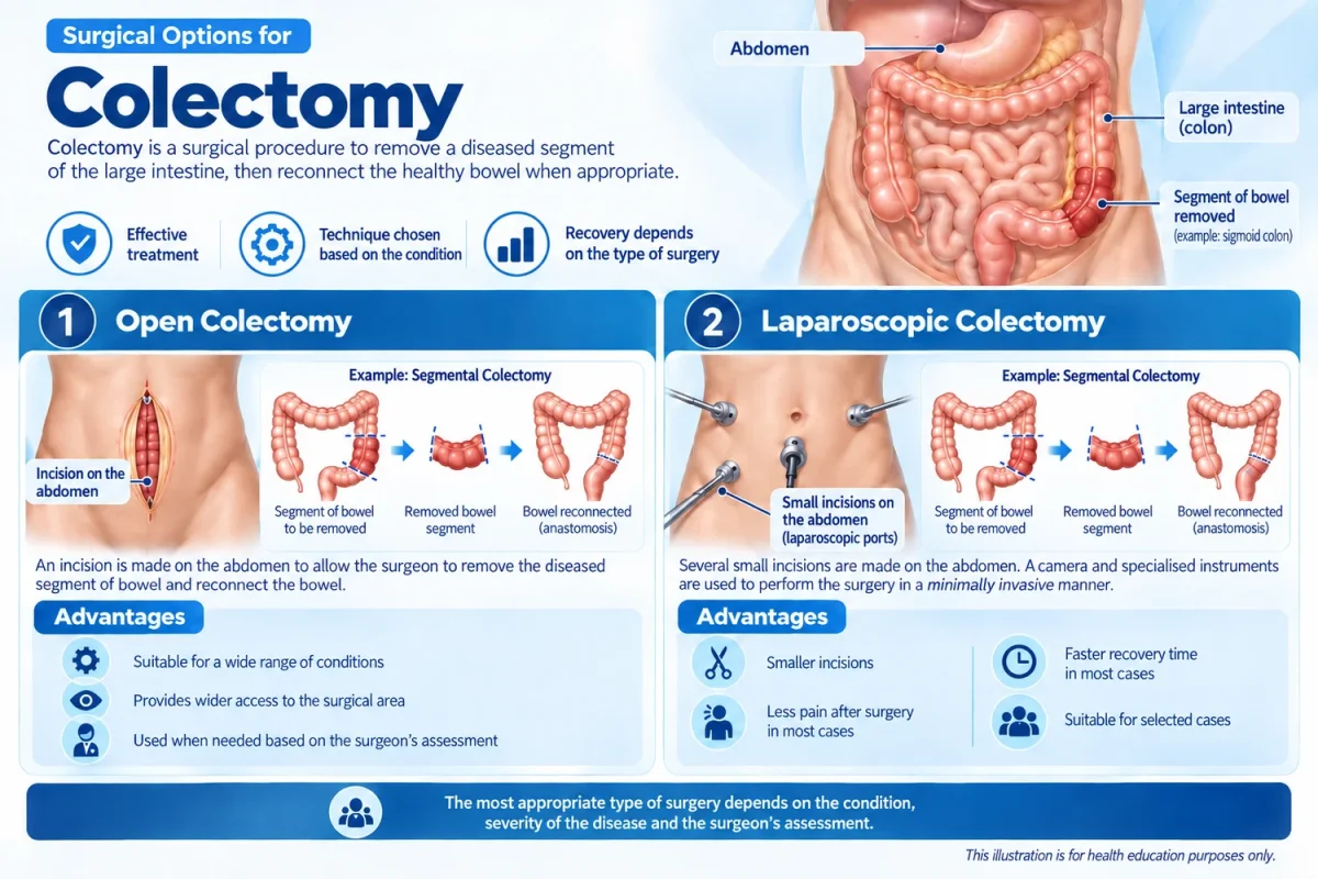 Infographic of colectomy, showing removal of the affected segment of the colon.