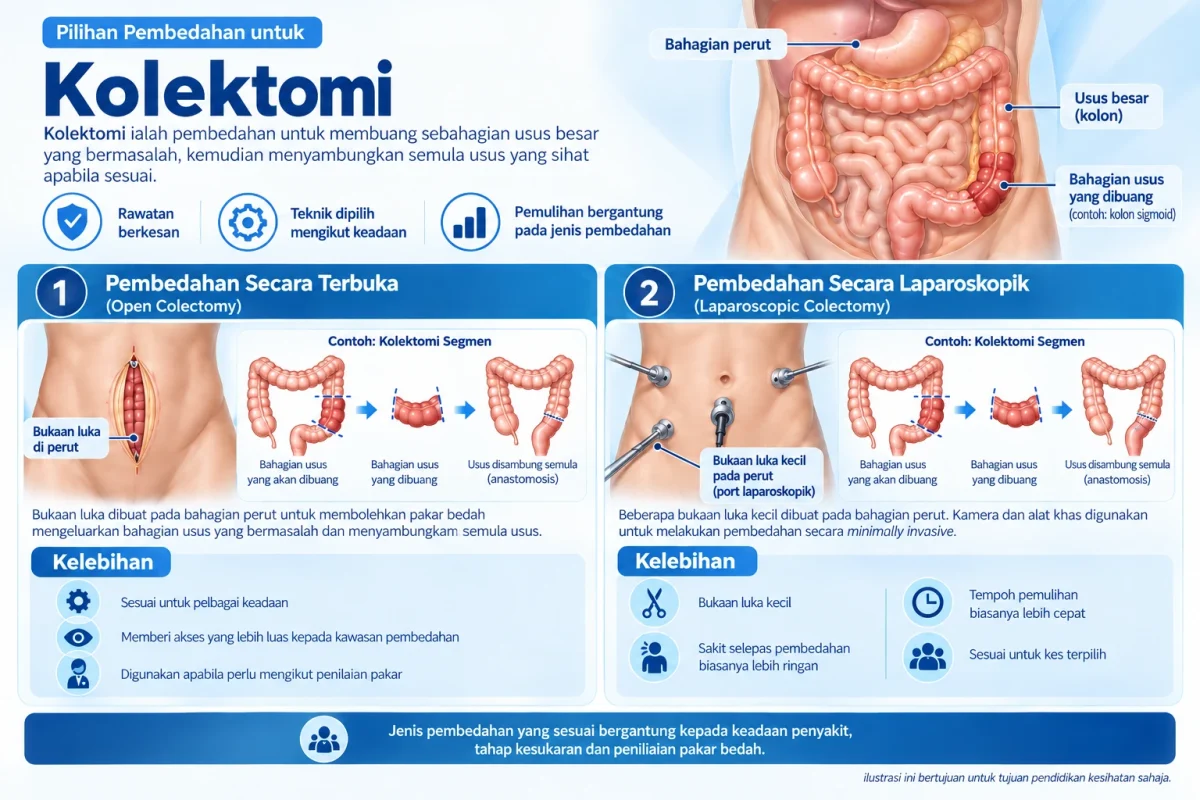 Infografik kolektomi.